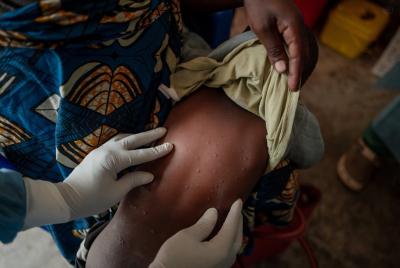 Le virus mpox se propage dans certaines régions d’Afrique. (Photo : Organisation mondiale de la santé via X.) Le virus mpox se propage dans certaines régions d’Afrique. (Photo : Organisation mondiale de la santé via X.)